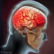 $3 million “diminished capacity” award for brain injury.